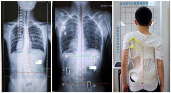 Boston Brace: First Check before X-Ray - Scoliosis and Spine