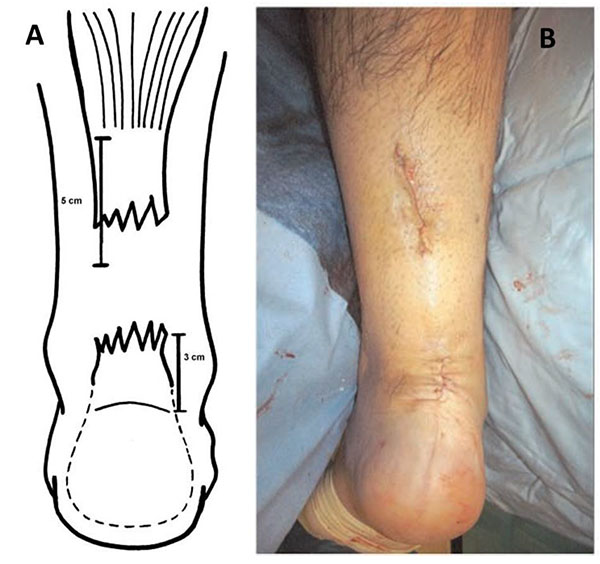 Chronic Achilles Tendon Rupture