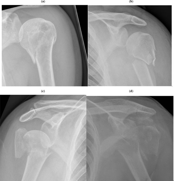 proximal humerus fracture presentation