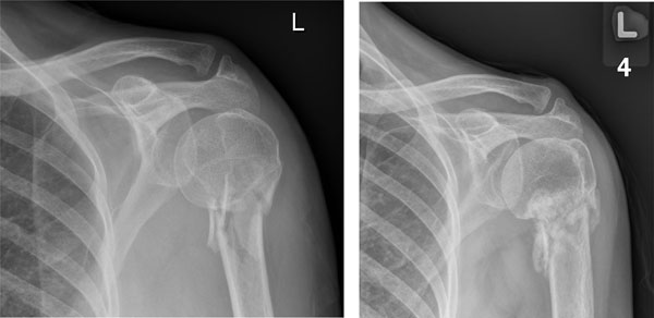 proximal humerus fracture presentation