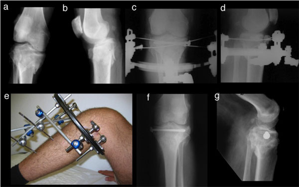 Ring external fixator (definitive) for Complete articular fracture,  fragmentary articular